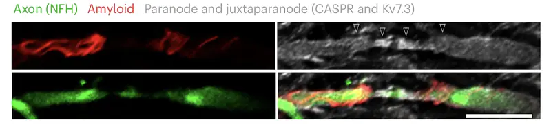 Expansion microscopy revealed amyloid fiber accumulation at the myelin-axon interface that showed spiral and helical patterns
