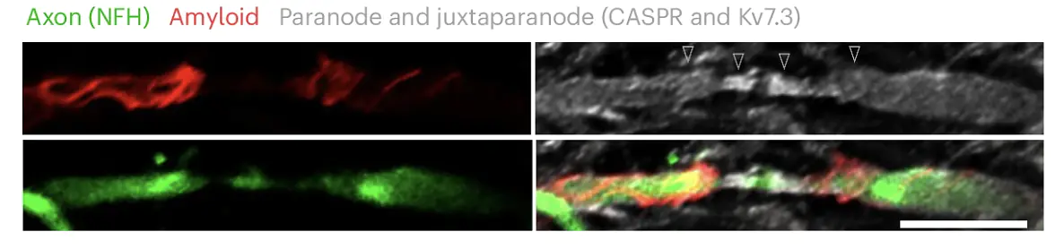 Expansion microscopy revealed amyloid fiber accumulation at the myelin-axon interface that showed spiral and helical patterns