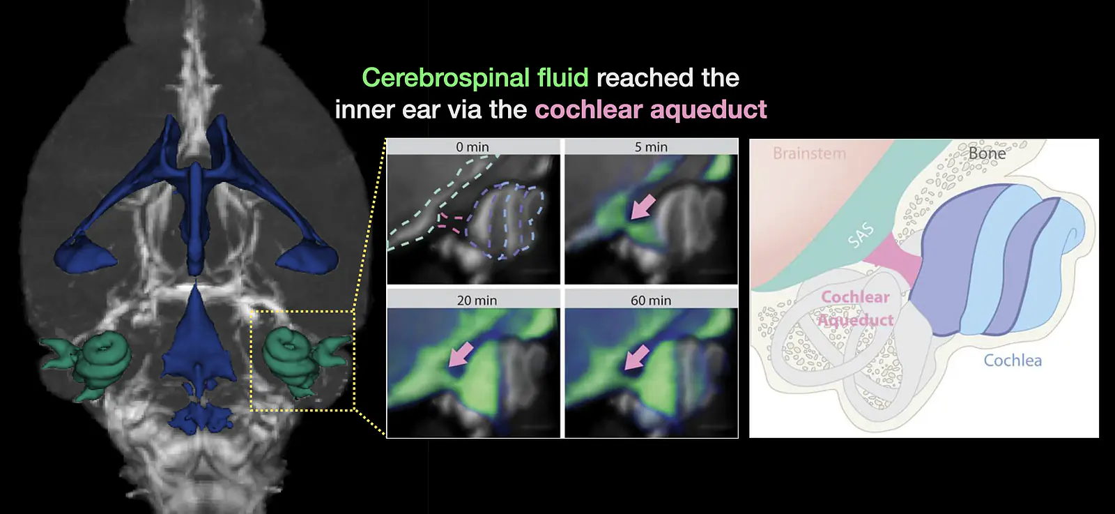 CSF Path in Cochlear Aqueduct