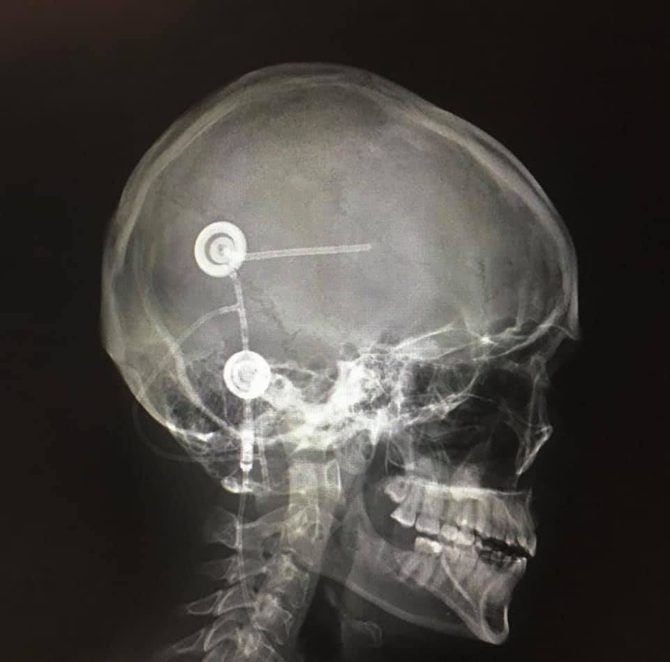 A radiograph image of a skull. A medical device, a cerebral ventricular shunt, is prominant in the image and shows two circular components well as several thin tubes running from the centre of the head, behing the ear and down the neck
