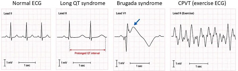 Inherited arrhythmia syndromes