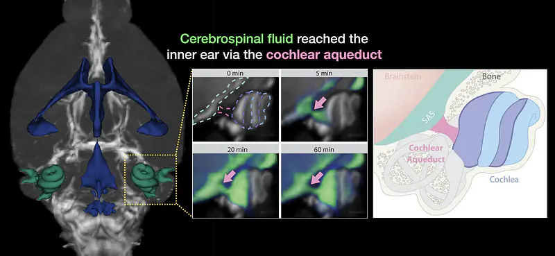CSF Path in Cochlear Aqueduct