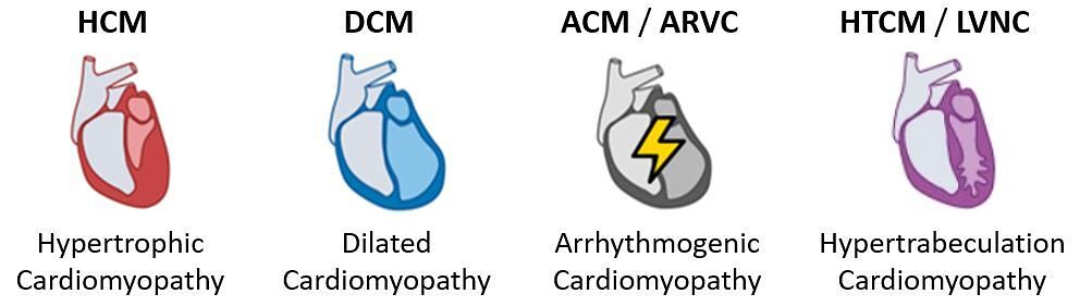 Cardiomyopathy sub-types