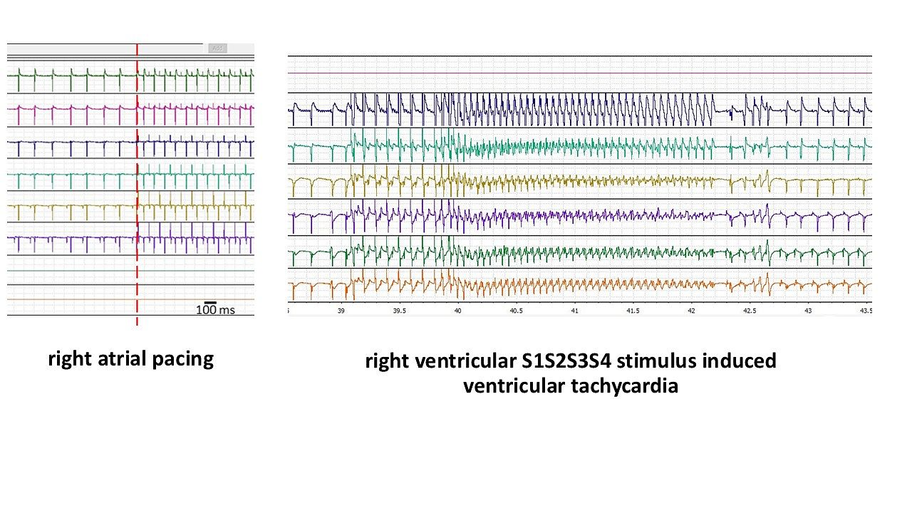 Picture of electrocardiograms generated by the Core.