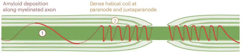 Working model of the amyloid pathology at the disrupted myelin-axon interface