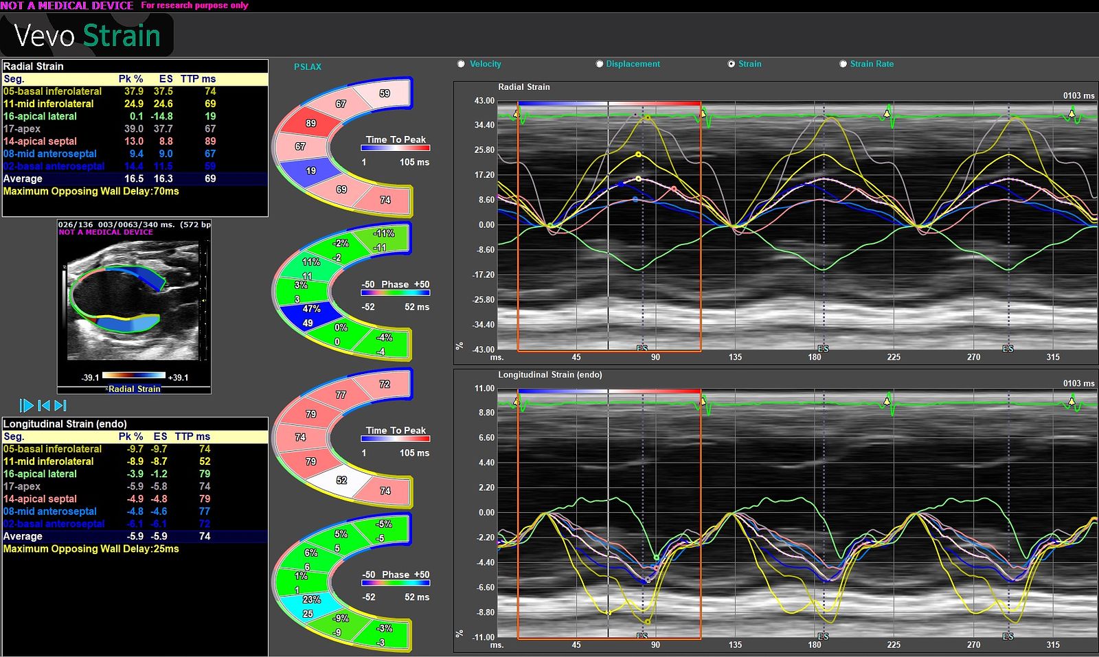 Image of data from strain echocardiography exam.