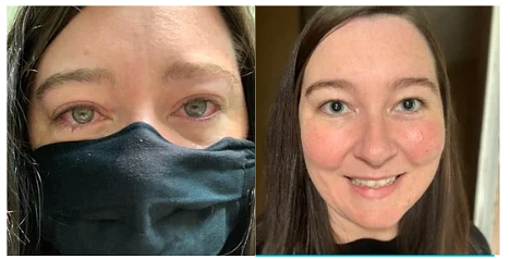  Side-by-side selfies of a young woman. On the left, she wears a black face mask over her nose and mouth. Her eyes are red and full of tears. On the right, she has a small smile. Her cheeks are rosy red and her large pupils are fully dilated.
