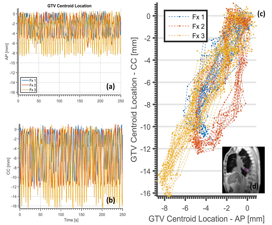 Initial clinical observations of intra-and interfractional motion variation in MR-guided lung SBRT, DOI: 10.1259/bjr.20170522